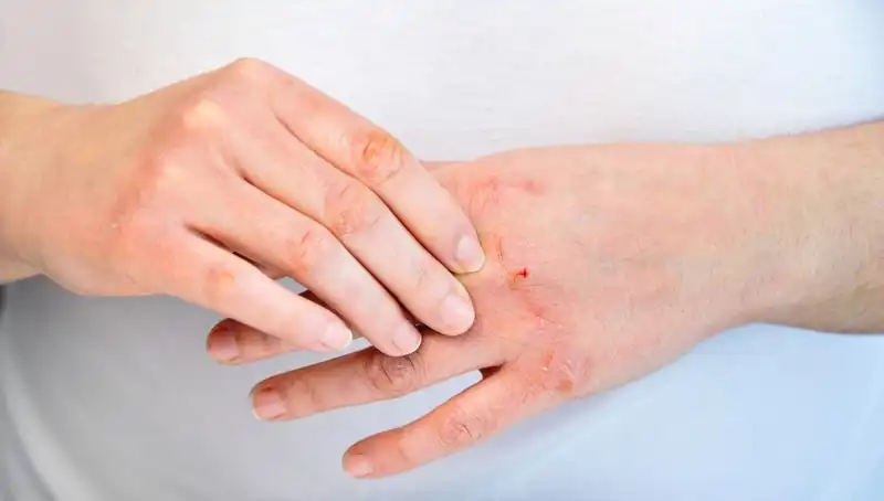 Yetersiz Protein Tüketimi Belirtileri: 6 Dikkat Edilmesi Gereken İşaret